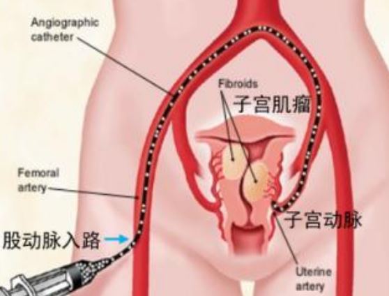 子宫肌瘤对生产的影响 子宫肌瘤会影响胎儿吗