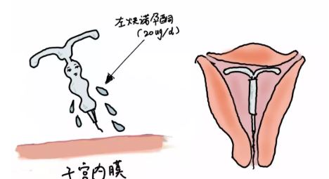 上曼月乐环后流血怎么回事 上曼月乐环流血是副作用吗