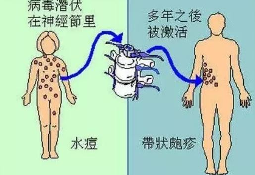 哺乳期乳房长带状疱疹怎么办 哺乳期长带状疱疹能哺乳吗