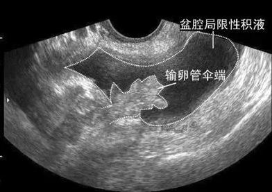 盆腔积液还能怀孕吗 盆腔积液怀孕几率大吗