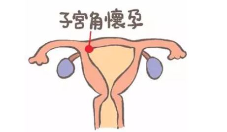 宫角妊娠最佳治疗方法 宫角妊娠的治疗方法有哪些