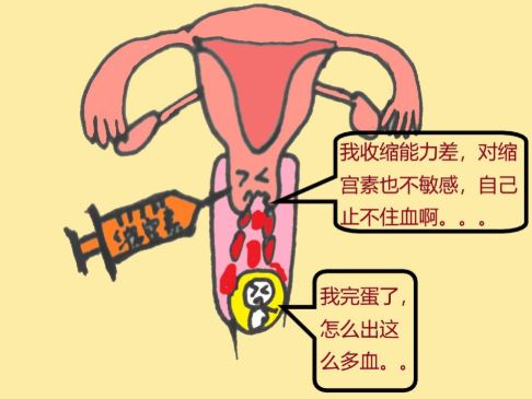 宫颈妊娠治疗难度大吗 宫颈妊娠妇科检查症状