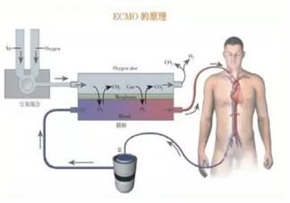 ecmo是什么意思 ecmo什么情况下用