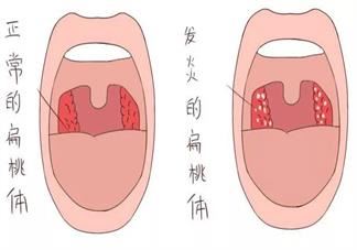 扁桃体经常发炎要切吗 孩子扁桃体经常发炎怎么护理