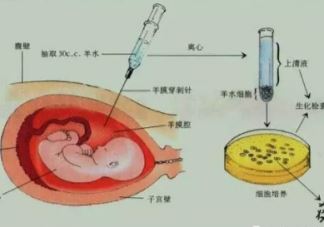 产前诊断有必要做吗   产前诊断作用介绍