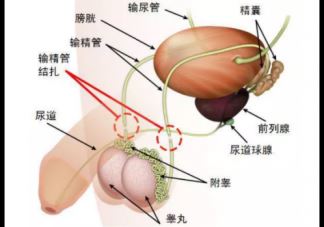 男性结扎有什么副作用 男性结扎影响性生活吗