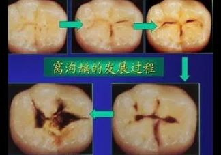 一岁半宝宝爱吃手怎么戒掉 宝宝爱啃手戒掉方法