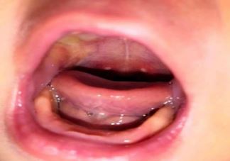 男孩戴风扇睡觉被吹面瘫是怎么回事 夏季为什么容易发生面瘫