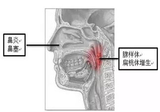 孩子睡觉的时候张口呼吸是什么原因 为什么会出现孩子张口呼吸的情况