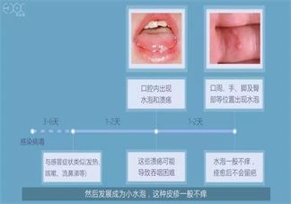 宝宝有眼垢是因为热气上火吗 孩子眼屎多是什么原因