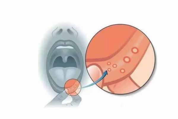 口腔溃疡为什么这么疼 口腔溃疡为什么是白的