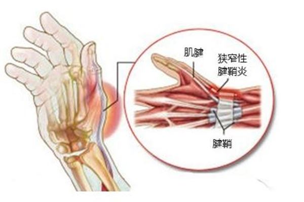 腱鞘炎是怎么形成的 腱鞘炎有什么症状