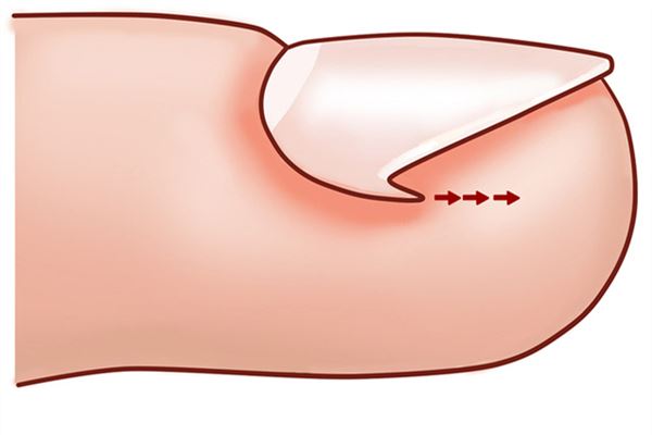 甲沟炎指甲长出来就好了吗 甲沟炎指甲长肉里好深怎么办