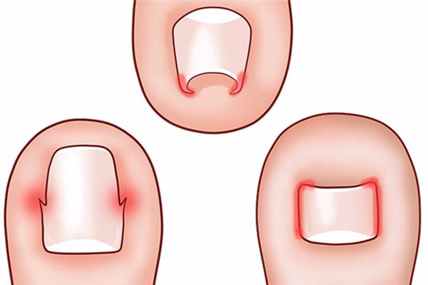 甲沟炎指甲怎么修剪 甲沟炎剪出血了怎么办
