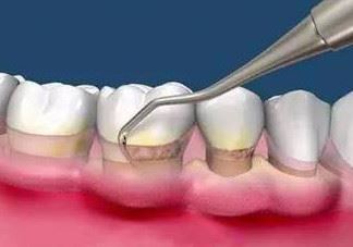 牙周炎怎么治疗效果最好？牙周炎怎么治疗小偏方