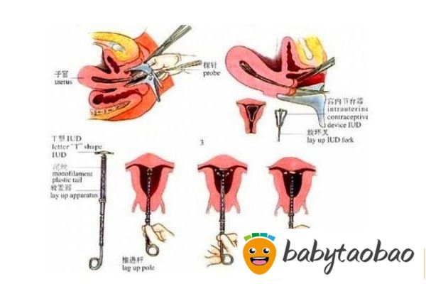 避孕环下移_避孕环下移的原因_避孕环下移怎么办
