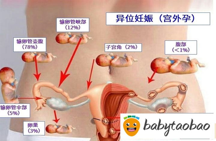 如何确诊宫外怀孕?宫外孕多久可以测量