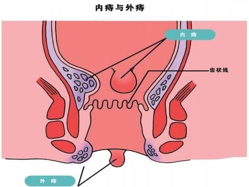 外痔病情急速缓解，最佳治疗方法揭秘