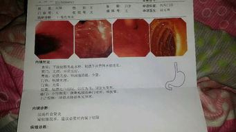 反流性食管炎怎么治疗,饮食注意事项和预防方法