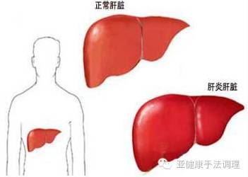 肝硬化的传染途径和预防措施