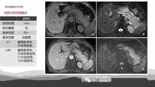 坏死性胰腺炎的症状和治疗方法,预防坏死性胰腺炎的注意事项