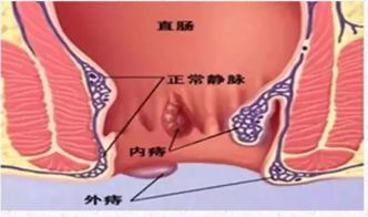 得了痔疮怎么治（详解痔疮的治疗方法）