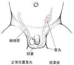 如何正确处理睾丸上的小肉球？