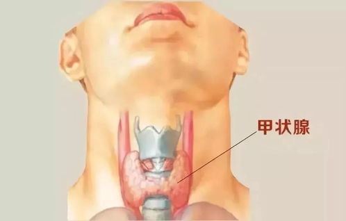 甲状腺结节患者的饮食禁忌与建议