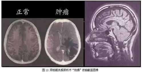 核磁共振技术的安全性与副作用解析