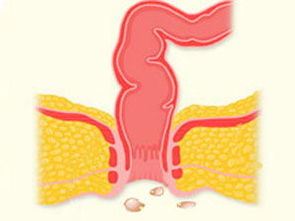 肛周湿疹治疗（详解肛周湿疹的症状和治疗方法）