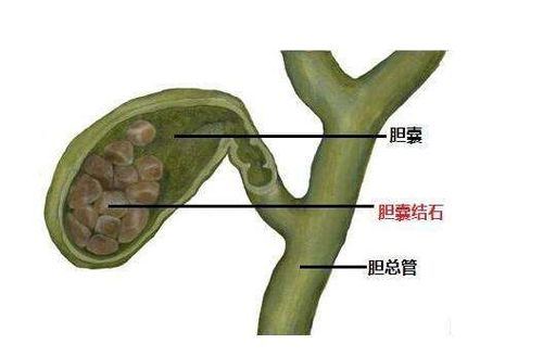 胆囊炎的症状治疗和预防