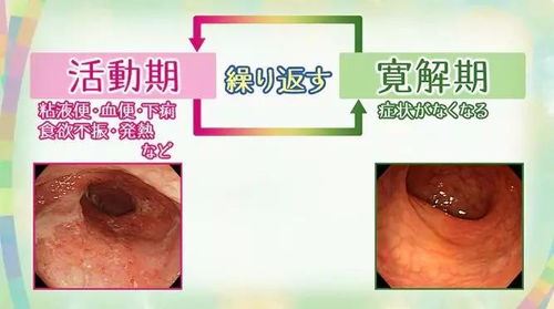 溃疡性大肠炎的症状和治疗方法详解