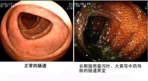 结肠黑变病的症状及治疗方法详解