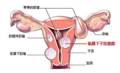 子宫肌瘤吃什么药好（详细介绍子宫肌瘤治疗方法）