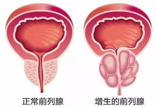 前列腺增生症的治疗方法和效果分析