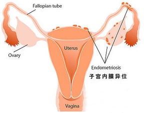 如何有效缓解子宫内膜移位的症状及治疗方法