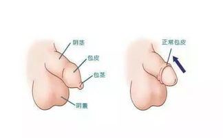 包皮过长的危害及其治疗方法