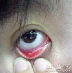 如何安全有效地进行麦粒肿手术操作