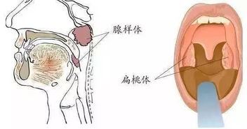 小孩打呼噜的原因及解决方法