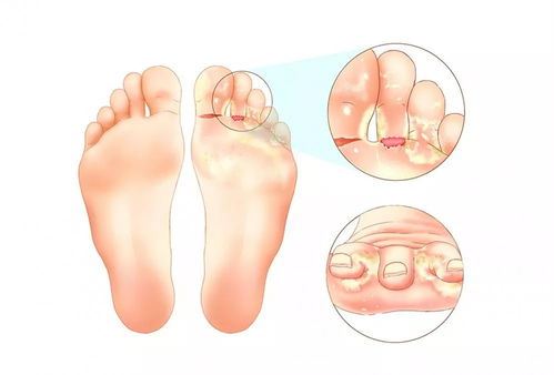 脚气治疗方法有哪些,脚气患者必看的预防知识