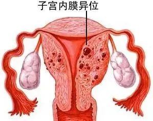 子宫腺肌症可以怀孕吗（影响怀孕的因素及治疗方法）