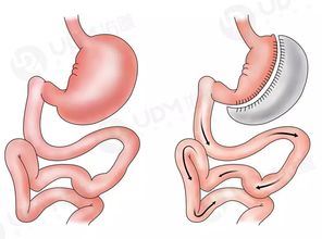 胃部减肥手术：重塑身材的有效方法
