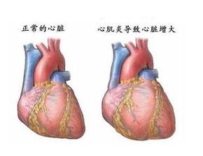 心肌炎的诊断（如何确定心肌炎的病情）