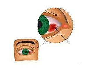 眼结膜下出血的原因和治疗方法