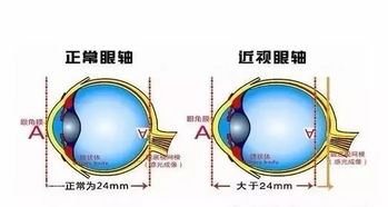 近视眼老花了怎么预防和治疗？近视眼和老花眼有什么区别？