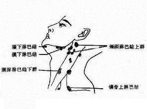 颈部淋巴结炎症状及治疗方法,如何预防颈部淋巴结炎发生