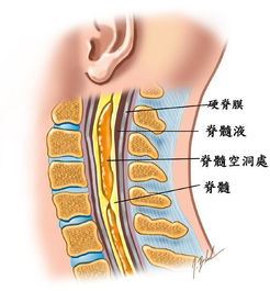 脊髓空洞症状及治疗方法,脊髓空洞手术后注意事项