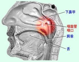 咽鼓管异常开放（症状及治疗方法介绍）