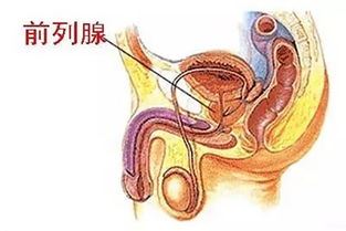 前列腺炎的传染途径及预防措施解析