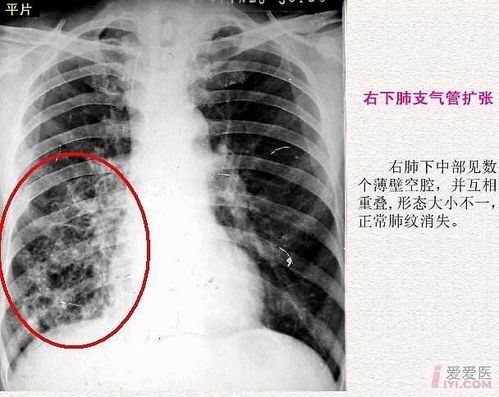 支气管扩张剂的用法和注意事项，不同品牌的支气管扩张剂对比分析